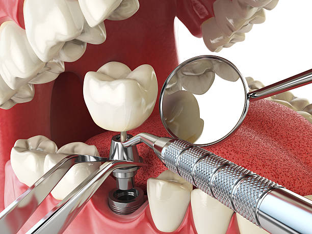 Dentist for Dental Trauma in WA